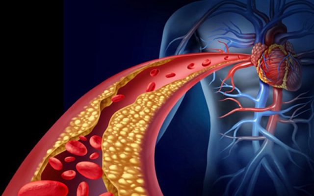 4 hiểu lầm phổ biến về mỡ máu