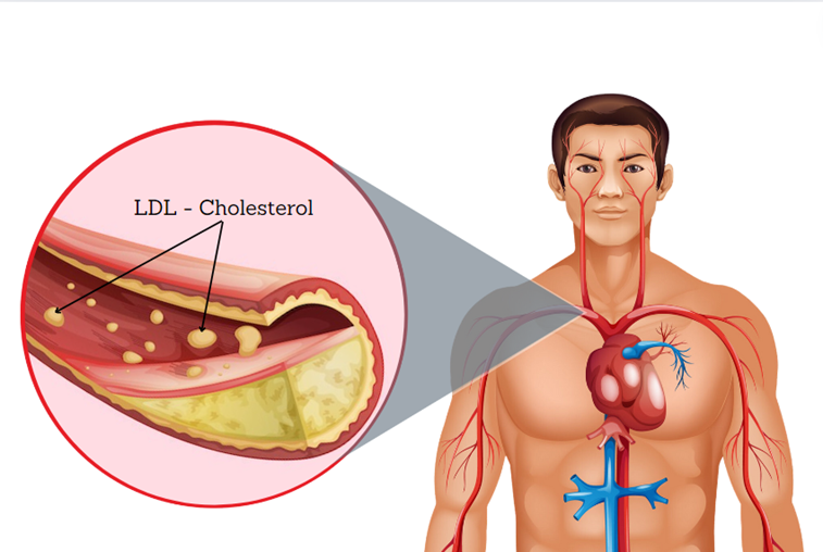 Chỉ số LDL cao có nguy hiểm không