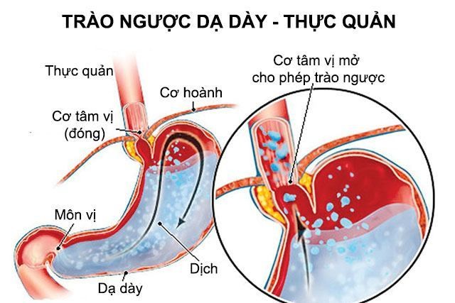Bệnh trào ngược dạ dày thực quản