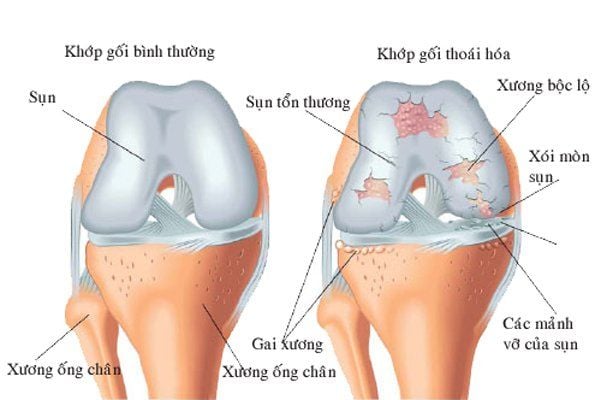 Hình ảnh minh họa sụn khớp gối bị bào mòn theo thời gian