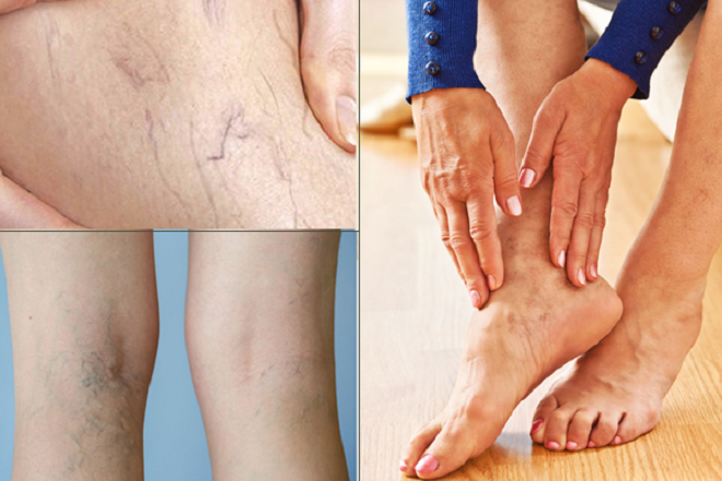 Cơ chế hình thành suy giãn tĩnh mạch chân do van tĩnh mạch suy yếu và máu ứ đọng