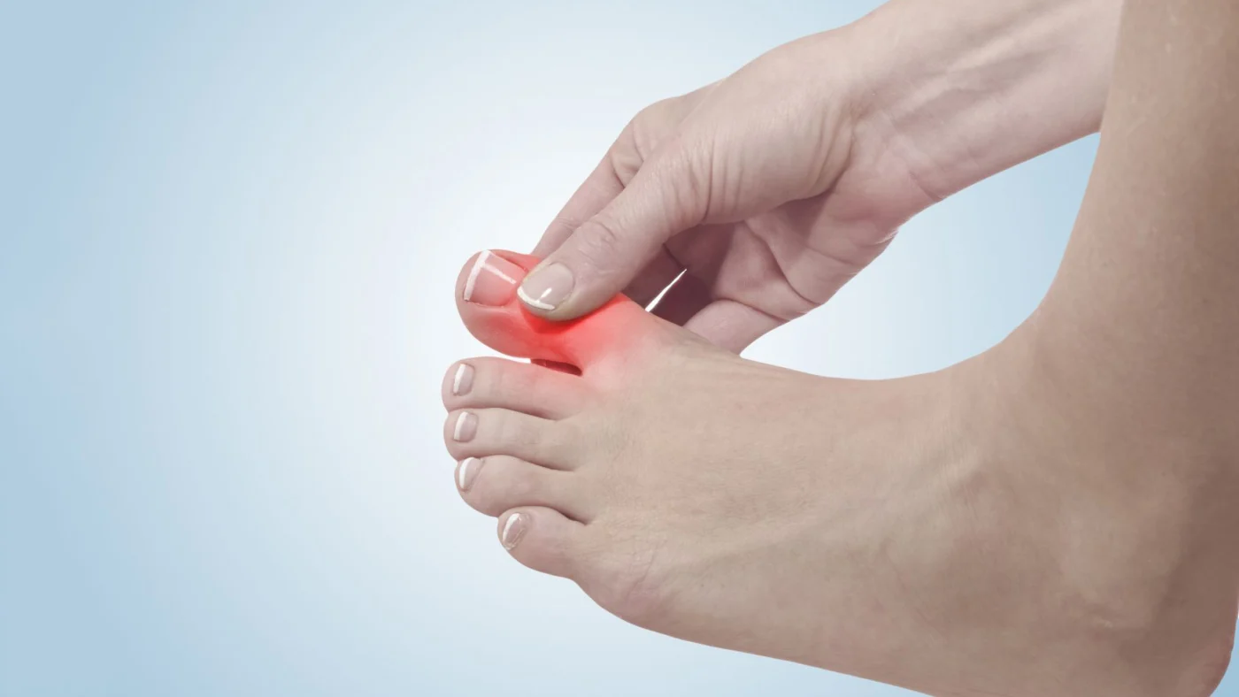 Người bị gout đau dữ dội ở ngón chân cái vào ban đêm
