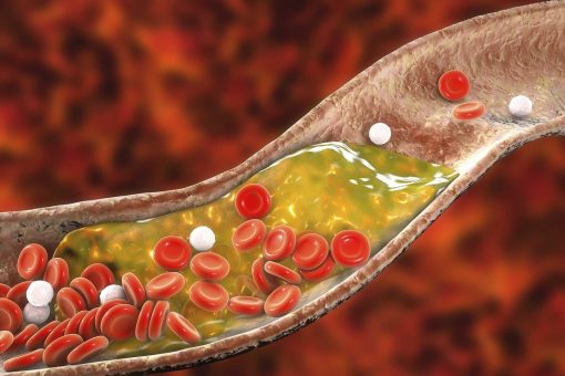 Tổng quan về cholesterol cao và các biến chứng nguy hiểm