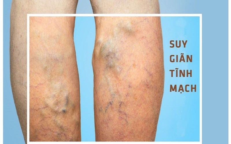 Minh hoạ cơ chế suy giãn tĩnh mạch chân – máu ứ trệ và van tĩnh mạch suy yếu