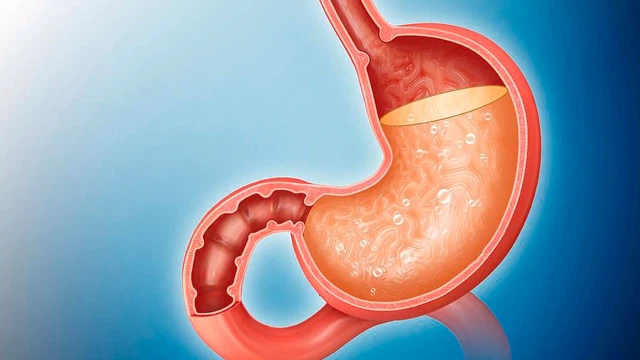 Hỗ trợ giảm trào ngược dạ dày thực quản hiệu quả