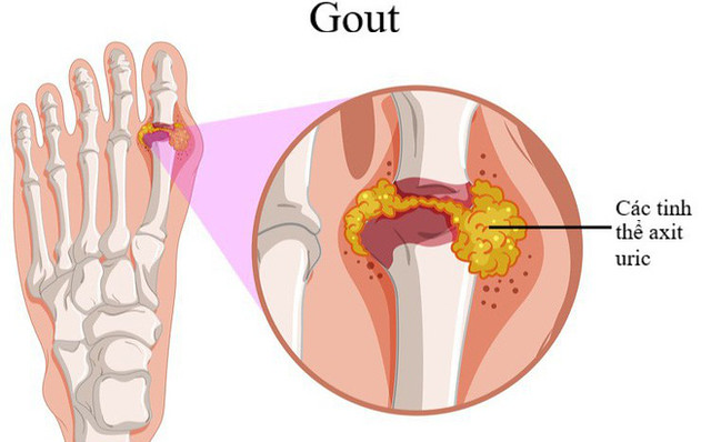 Tinh thể acid uric gây sưng viêm khớp ở người bị gout