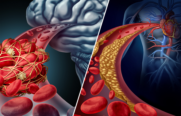 Mạch máu bị tắc nghẽn do cholesterol cao