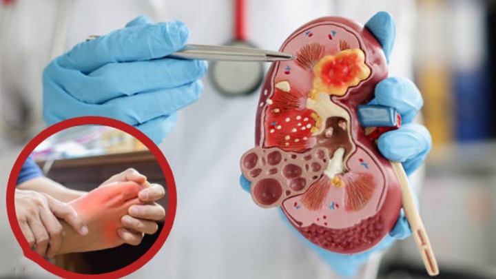Người bị gout có nguy cơ tổn thương thận nghiêm trọng