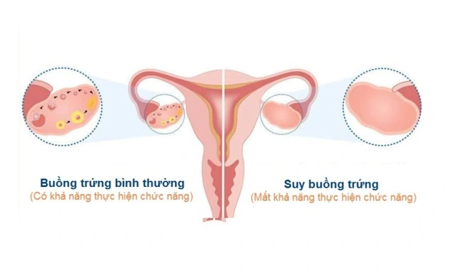 Estrogen và progesterone suy giảm trong giai đoạn tiền mãn kinh