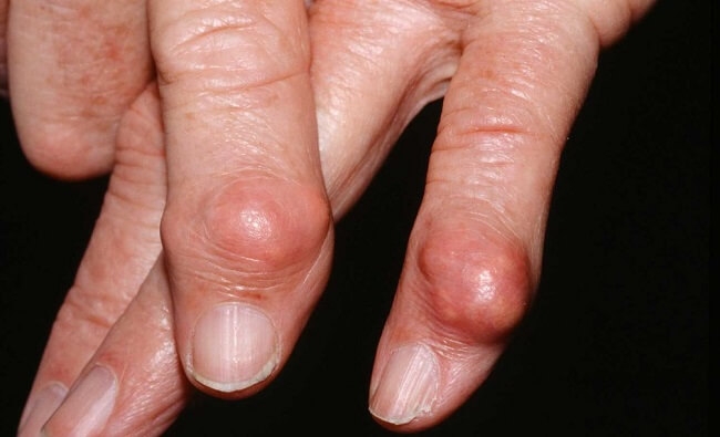 Tophi nổi dưới da cảnh báo người bệnh bị gout mạn tính