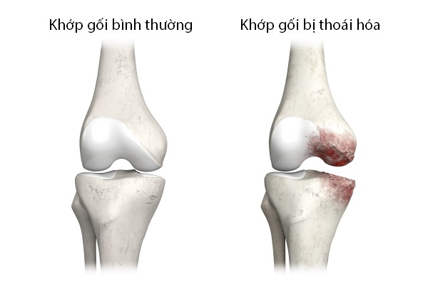 Cấu tạo khớp gối và các vị trí dễ tổn thương gây đau nhức