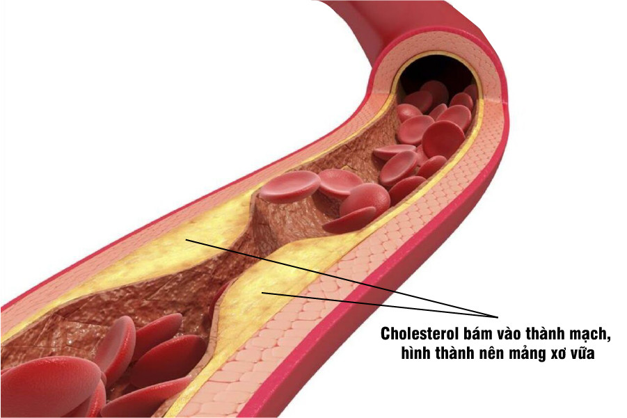 Cholesterol cao gốc rễ của mỡ máu cao