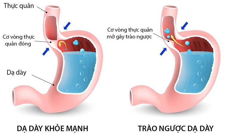 Minh họa cơ chế trào ngược dạ dày thực quản do cơ vòng yếu