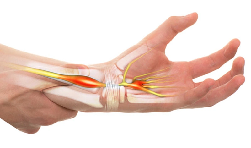 Hội chứng ống cổ tay gây tê và giảm cảm giác