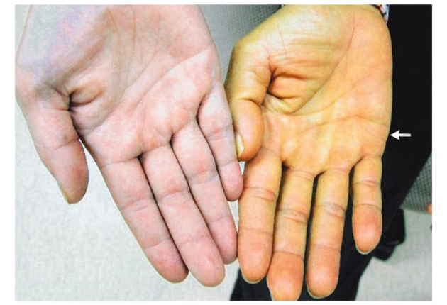 Triệu chứng men gan cao thường âm thầm và dễ bỏ qua