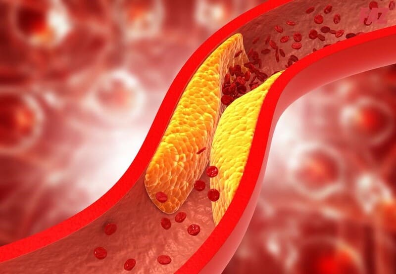 Mạch máu bị xơ vữa do mỡ máu cao gây tắc nghẽn.