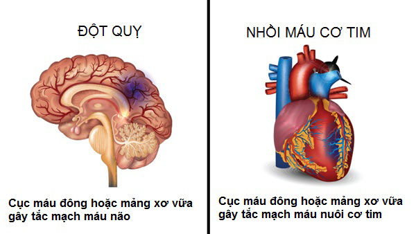 Mỡ trong máu bám vào thành mạch gây xơ vữa và đột quỵ