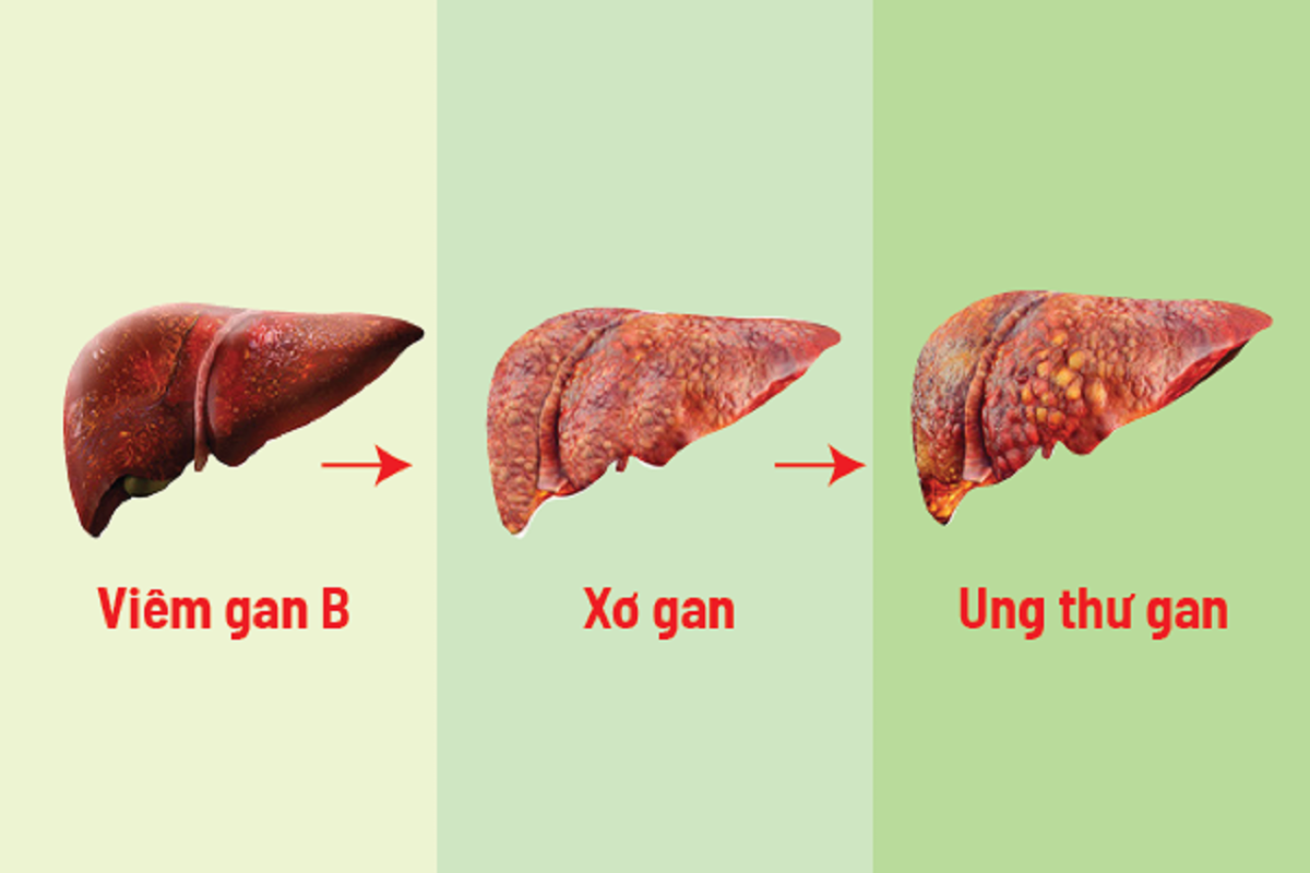 Hình ảnh minh họa tổn thương gan từ viêm đến xơ gan, ung thư gan
