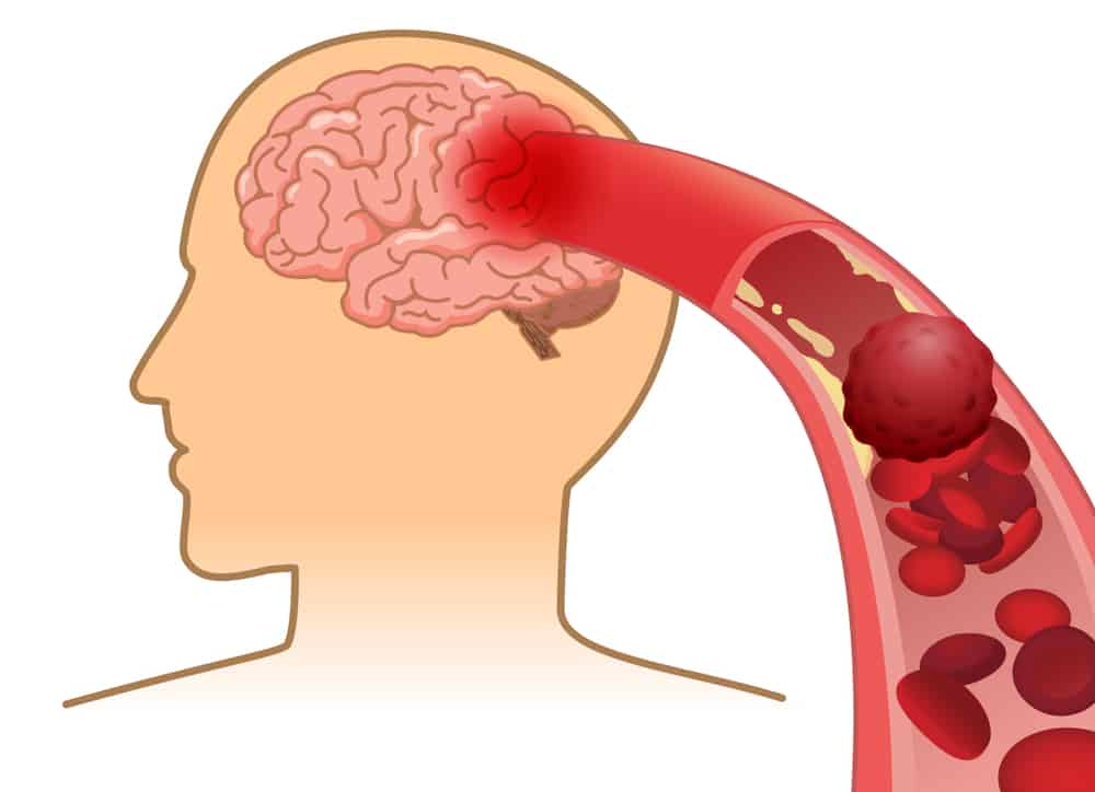 Hình ảnh tổn thương não do triglyceride cao tích tụ lâu ngày