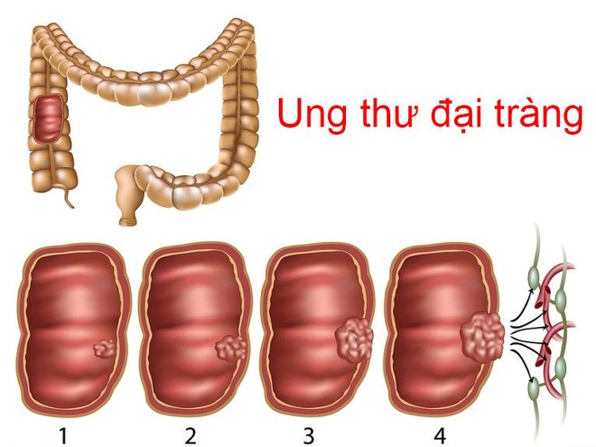 Biến chứng do táo bón lâu ngày: trĩ, viêm đại tràng, ung thư đại tràng,..