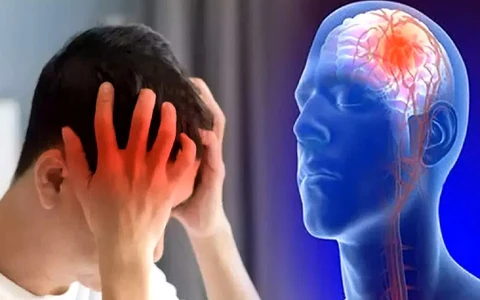 10 dấu hiệu cảnh báo đột quỵ sớm trước 30 ngày