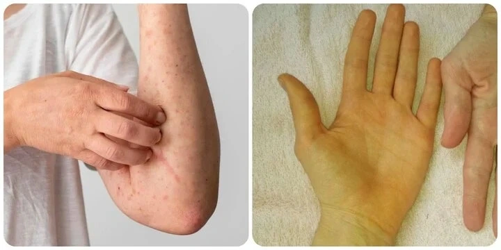 Dấu hiệu men gan tăng vàng da, ngứa