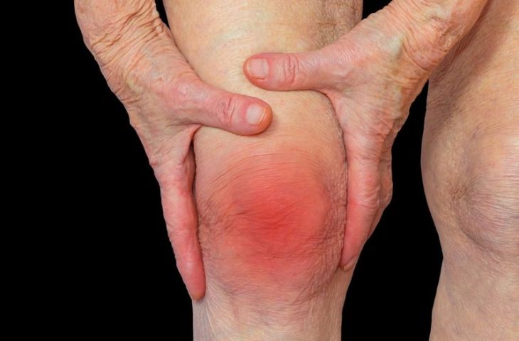 khớp gối bị sưng nóng nhẹ