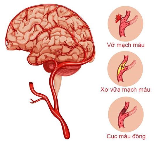 Hình ảnh minh họa đột quỵ do tắc mạch và vỡ mạch máu não