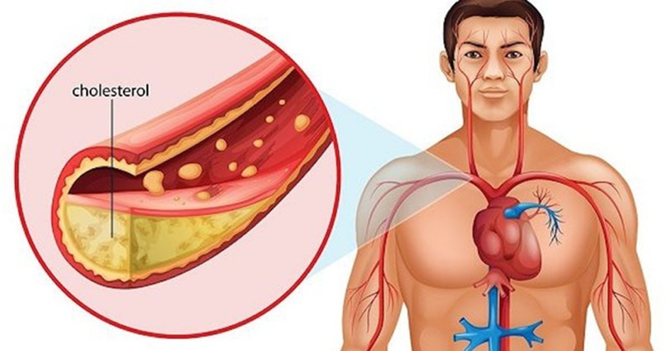 LDL cholesterol gây tích tụ tạo mảng xơ vữa trong động mạch