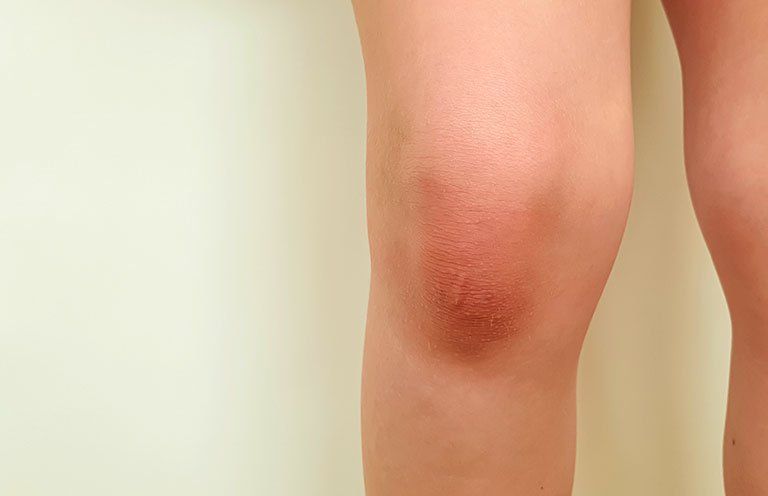 Đầu gối sưng to do tràn dịch khớp gối