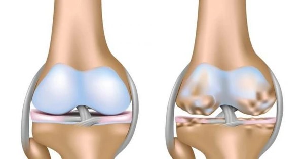 Nguyên nhân gây tràn dịch khớp gối do khớp bị mòn dần theo thời gian,.. 