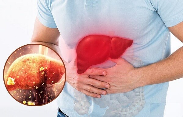 Gan nhiễm mỡ – cảnh báo sớm men gan cao