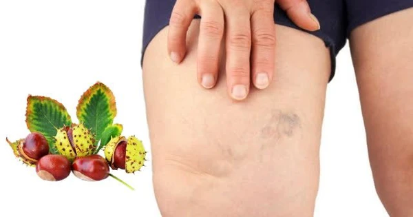 Hạt dẻ ngựa hỗ trợ tăng độ bền tĩnh mạch