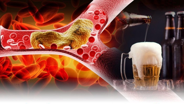 Uống rượu bia ngày Tết làm tăng nguy cơ đột quỵ