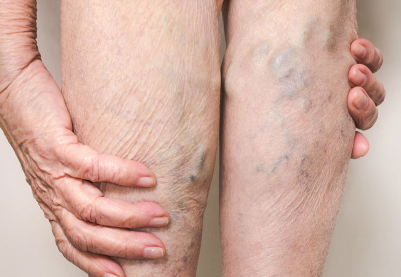 Gân xanh hiện rõ trên da ở người bị suy giãn tĩnh mạch chân