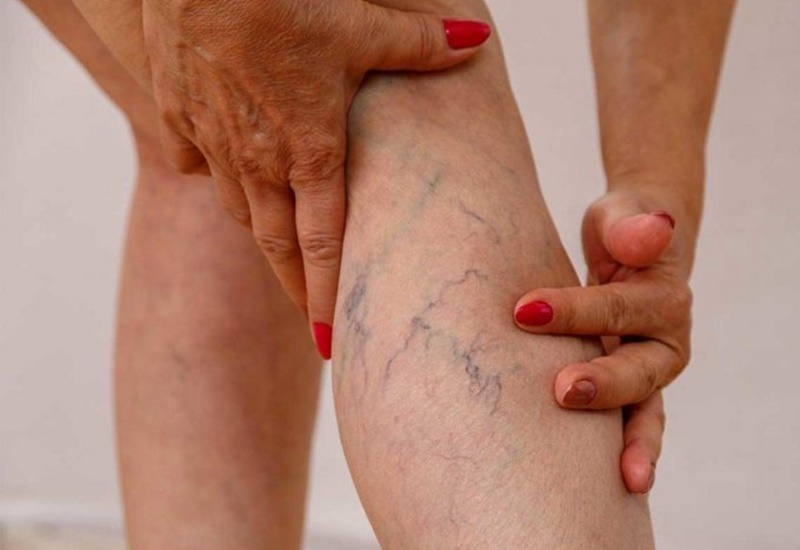 Dấu hiệu sớm suy giãn tĩnh mạch chân