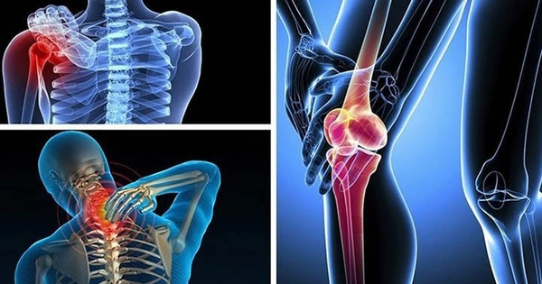 thoái hóa khớp với sụn khớp bị mòn và xương cọ xát