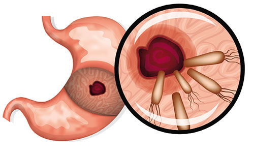 Vi khuẩn Hp - tác nhân hàng đầu gây đau dạ dày mãi 