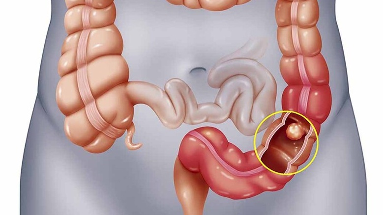 Táo bón gây đầy hơi chướng bụng