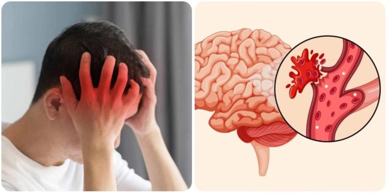 Đột quỵ bắt đầu từ mạch máu bị tổn thương âm thầm trong nhiều năm