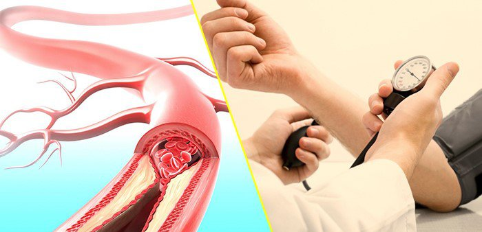 Huyết áp cao làm tăng nguy cơ đột quỵ do tổn thương mạch máu não