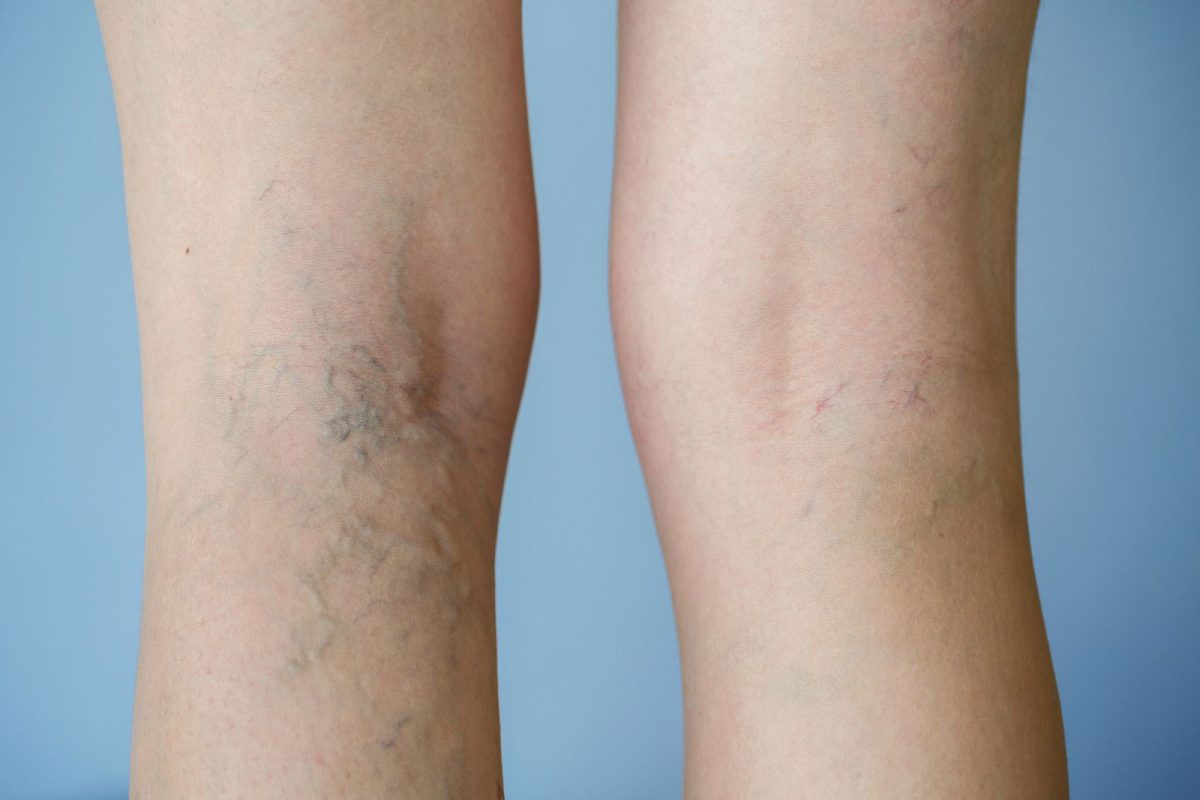 Mức độ suy giãn tĩnh mạch chân