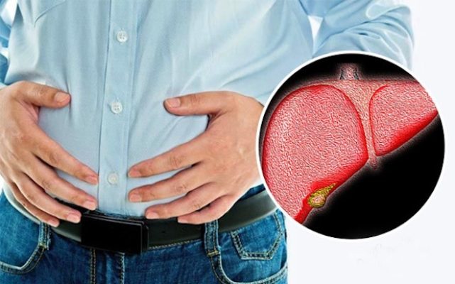 Gan nhiễm mỡ và 5 dấu hiệu cảnh báo cô bác anh chị không nên chủ quan