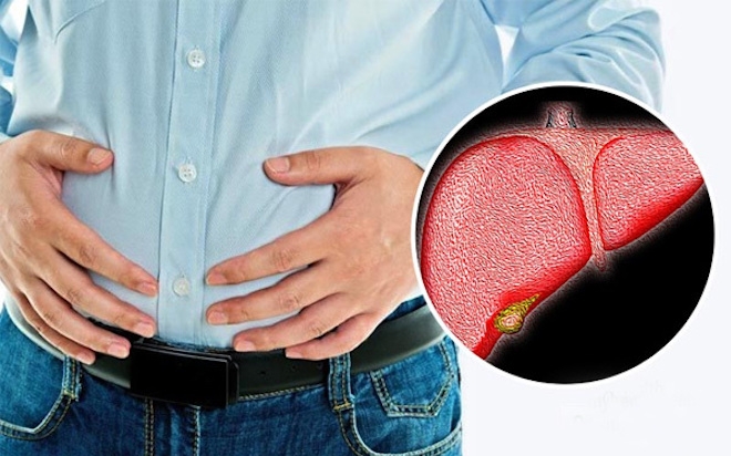 Gan nhiễm mỡ và 5 dấu hiệu cảnh báo cô bác anh chị không nên chủ quan