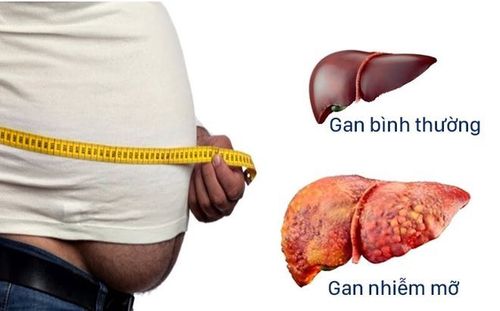 Gan nhiễm mỡ liên quan đến bụng to và mỡ máu cao