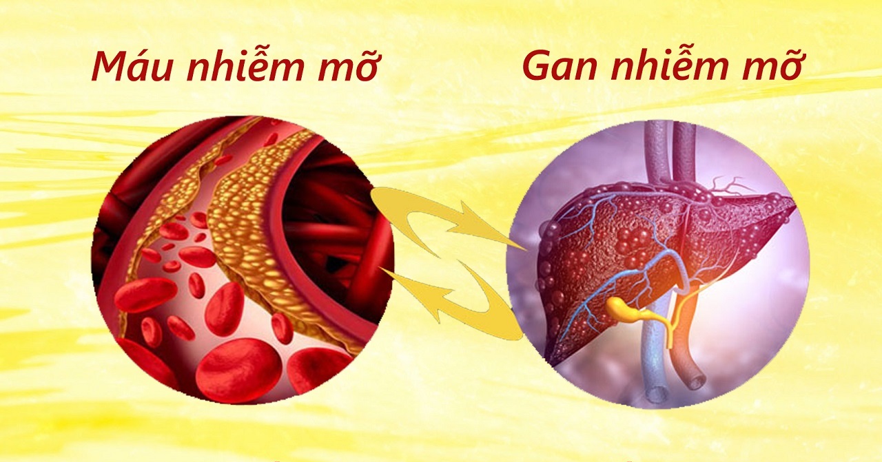 Mỡ máu cao làm tăng nguy cơ gan nhiễm mỡ