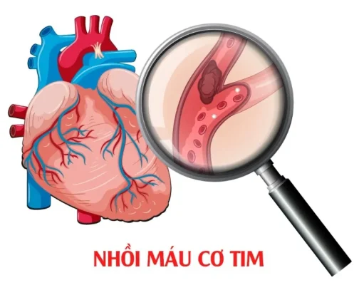 Nhồi máu cơ tim vẫn có thể xảy ra khi chỉ số mỡ máu bình thường