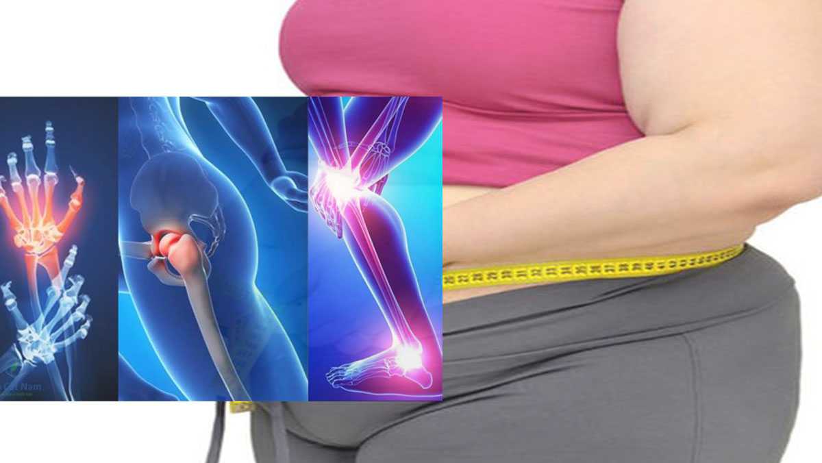 Béo phì làm tăng áp lực lên khớp gối 
