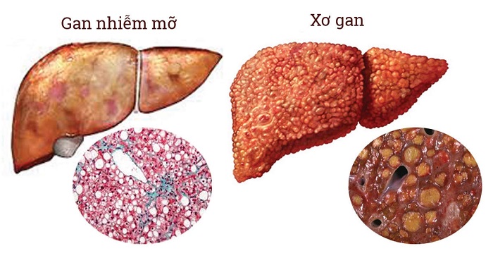 Gan nhiễm mỡ gây xơ gan 